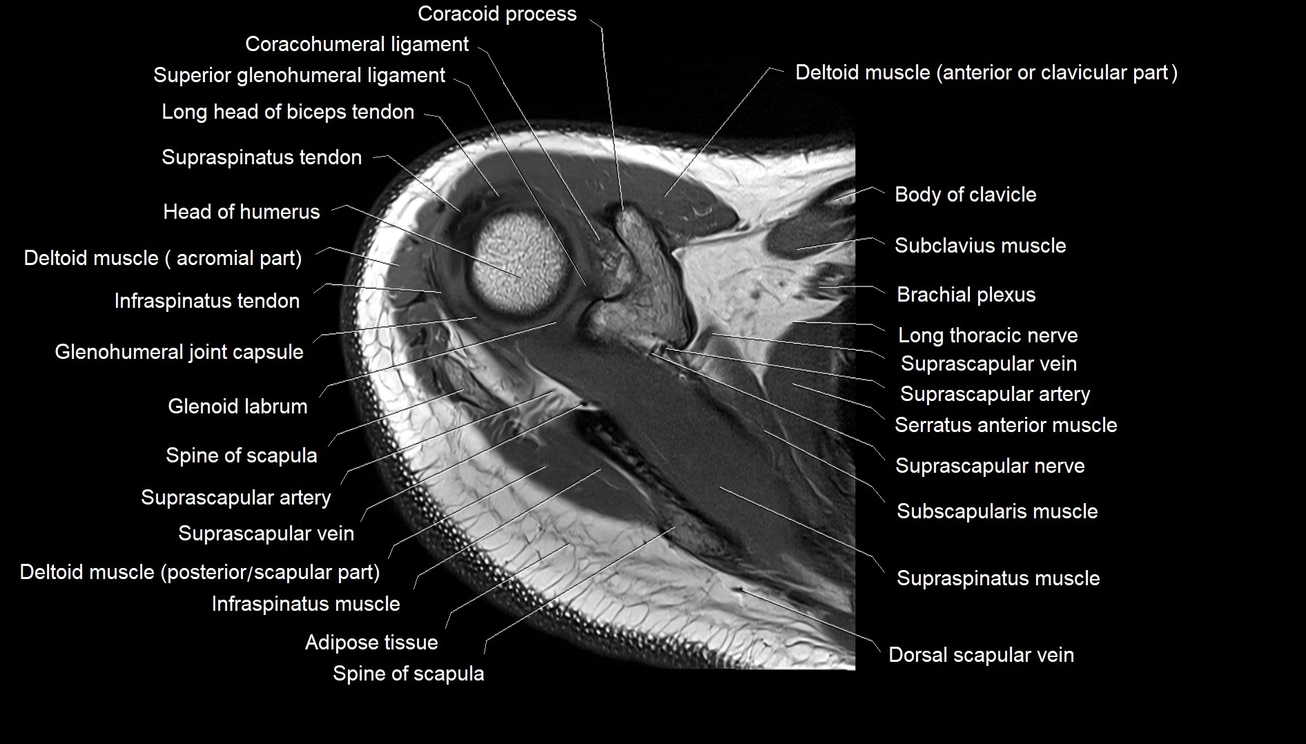 Shoulder cross sectional anatomy MRI 3T axial image 12.webp